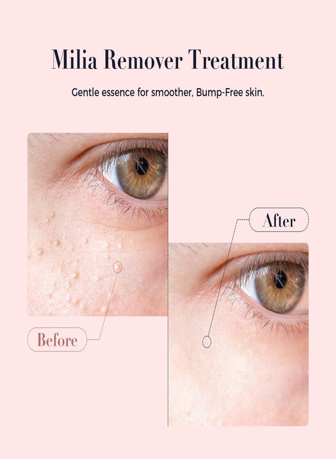 Kisinly Milia Remover for Eye & Face, Milia Spot Treatment Serum with Salicylic Acid,Milia Acne Cream - Image 3